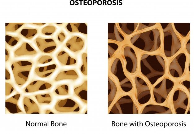 تفاوت استخوان سالم با استخوان مبتلا به پوکی استخوان